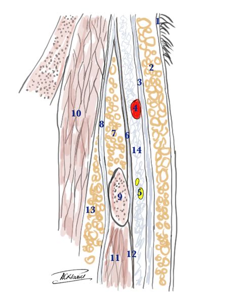 Temporal Artery Biopsy - StatPearls - NCBI Bookshelf