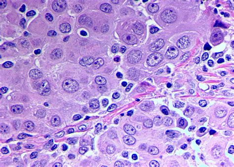 Pleural Mesothelioma Metastasis Sites