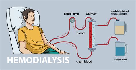 illustration of hemodialysis diagram 24318104 Vector Art at Vecteezy