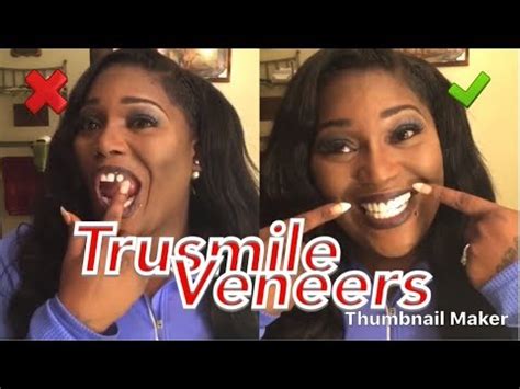 TruSmile veneers Review... Amazing! U gotta come see.... - YouTube