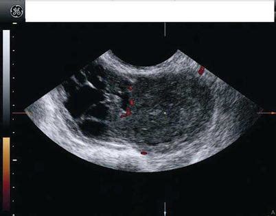 Ovarian Fibroma Ultrasound