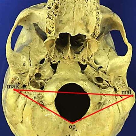 Comparative illustration of the opisthion-bimastoid triangle variables... | Download Scientific ...