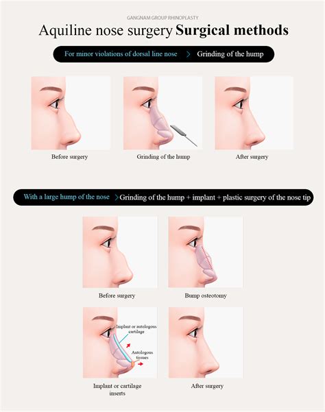 Aquiline nose – mob | Gangnam Group Plastic Surgery