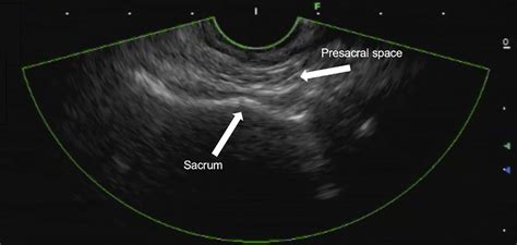 Ultrasound landmarks to identify ganglion impar location.... | Download Scientific Diagram