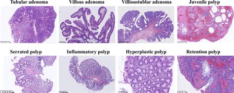 Different types of colonic polyps with hematoxylin-eosin staining ...