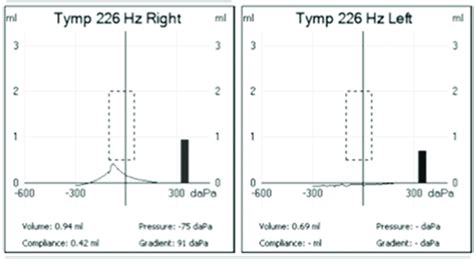 First tympanometry, showing type A in right ear, which is normal... | Download Scientific Diagram