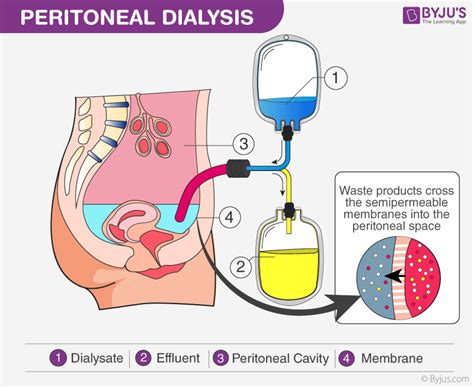 Peritoneal Dialysis Principle | My XXX Hot Girl