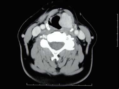 Paragangliomas of the Head and Neck | Ento Key