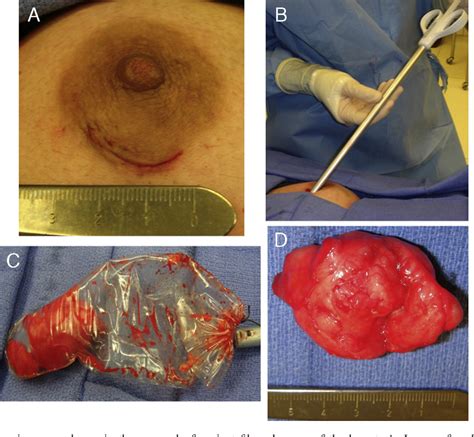 Figure 1 from Endoscopic specimen pouch technique for removal of giant ...