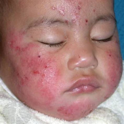 The Link Between Eczema and Food Allergies