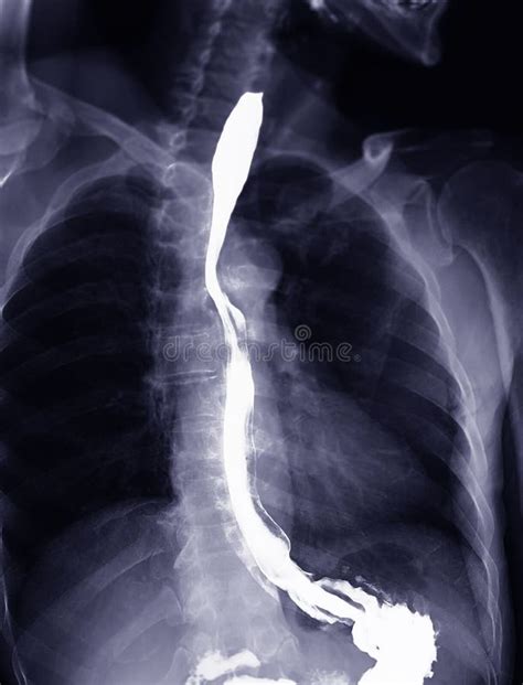 Normal Barium Swallow Esophageal