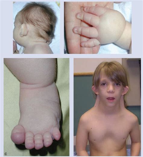Turner Syndrome | United States| PDF | PPT| Case Reports | Symptoms ...