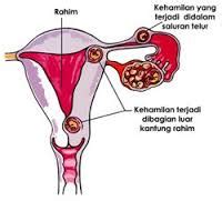 Kehamilan Ektopik Terganggu - Hamil.co.id