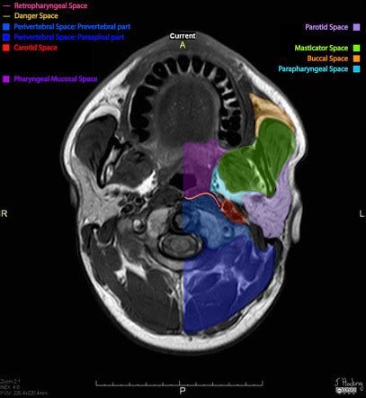 Parotid Gland Anatomy