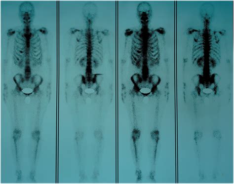 Bone scintigraphy showing sites of abnormal radioactivity concentration ...