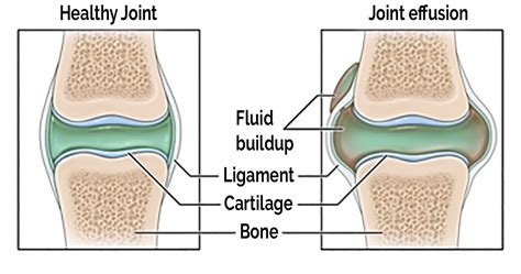 Ankle joint effusion - Capitol Imaging Services