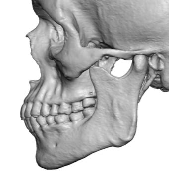 The Significance of the Antegonial Notch in Custom Jawline Implant Designs - Explore Plastic Surgery