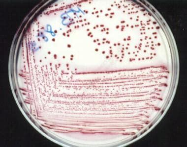 Escherichia coli (E coli) Infections Workup: Laboratory Studies, Imaging Studies, Other Tests