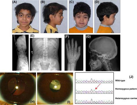 Marshall syndrome causes, symptoms, diagnosis, treatment & prognosis