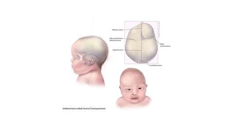 Craniosynostosis: Causes, Diagnosis, Treatment - StoryMD