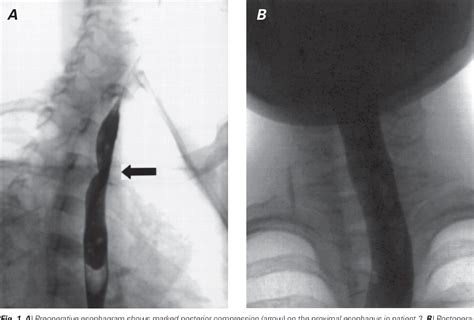 Figure 1 from Surgical approaches to the aberrant right subclavian ...