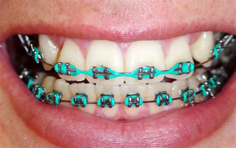 Green Teal Braces Colors – Warehouse of Ideas