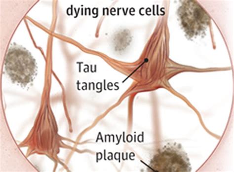 tau tangles News Research Tags Articles - Neuroscience News