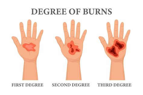 Burn stages. Burnt hands at various degrees. Skin burn symptoms ...