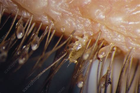 Lice on eyelashes - Stock Image - M240/0423 - Science Photo Library