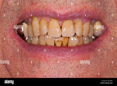 A MODEL RELEASED close up of an elderly mans decaying teeth Stock Photo - Alamy