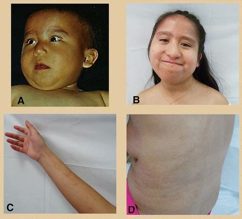 Partial and complete trisomy 14 mosaicism: clinical follow-up, cytogenetic and molecular ...