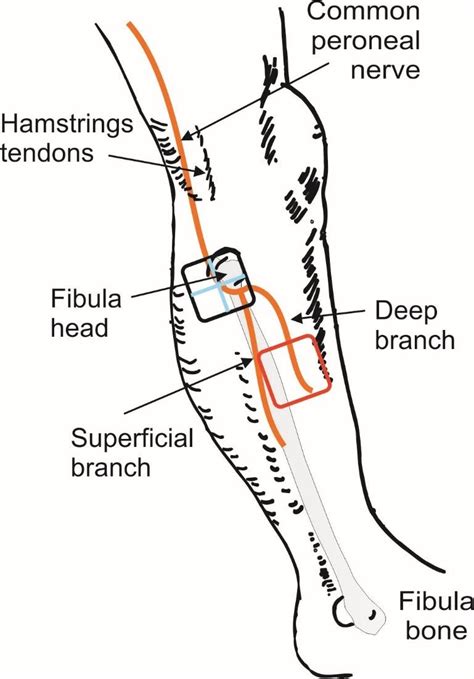 Electrode positions shown relative to the underlying common peroneal... | Download Scientific ...