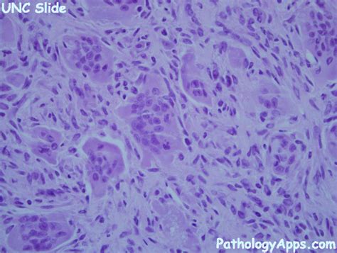 granular cell tumor pathology