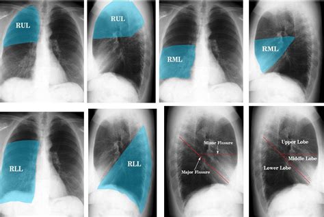 right lung anatomy | Lung lobes, Pediatric radiology, Medical school stuff