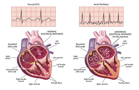 Atrial Fibrillation - Ganiyu Oshodi, MD - Temecula Heart Specialist