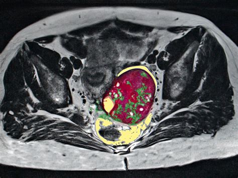 Ovarian cysts can be ‘watched’ rather than removed to avert surgical complications, study ...