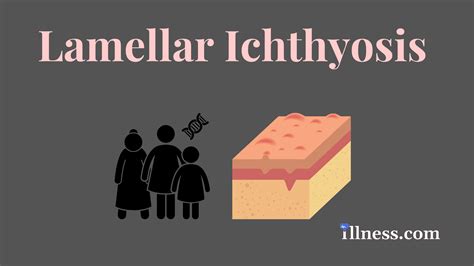 Lamellar Ichthyosis : Overview, Causes, Symptoms, Treatment - illness.com