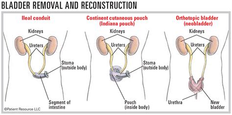 Bladder Cancer Reconstruction