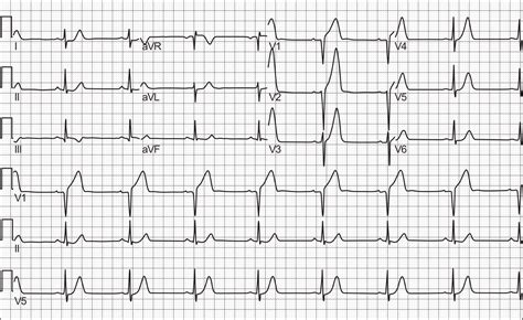 File:Myocardial infarction ECG.png