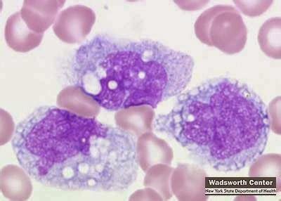 Fichero de Hematología Heber Mayén: Monoblasto