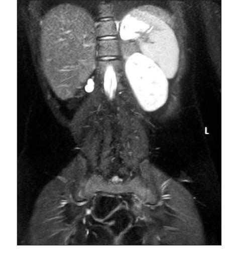 Figure 3 from Uterine conserving surgery in a case of cervicovaginal agenesis with unicornuate ...