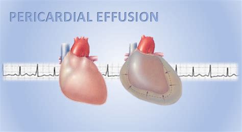 Pericardial Effusion - Causes, Symptoms, Diagnosis, Prognosis, Treatment