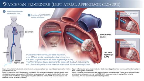 WATCHMAN Device (Left Atrial Appendage Closure) — LOGAN WEIHE