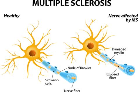 7 Early Warning Signs of Multiple Sclerosis - Regional Neurological Associates