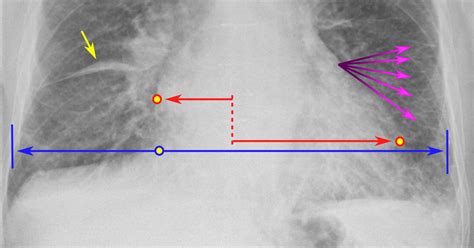 Kerley B Lines Cxr : Septal lines in lung | Radiology Reference Article ...