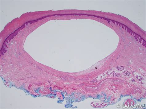 Digital Mucous Cyst (DMC)