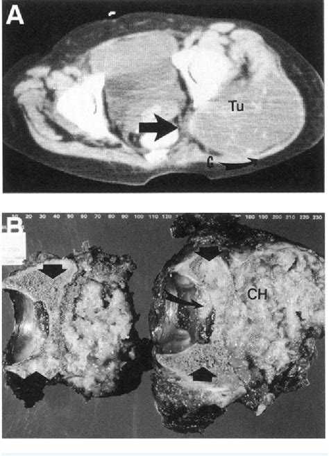 Figure 19.1 from 19 Anterior Flap Hemipelvectomy | Semantic Scholar