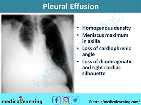 Pleural effusion | Respiratory therapy, Pleural effusion, Radiography