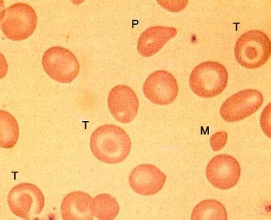 Beta Thalassemia Workup: Approach Considerations, Laboratory Studies, Prenatal Diagnosis