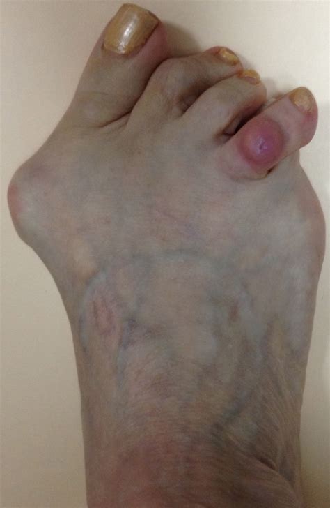 crossover toe before & after - Advanced Podiatry of Manhasset, Huntington, Coram, Woodbury ...